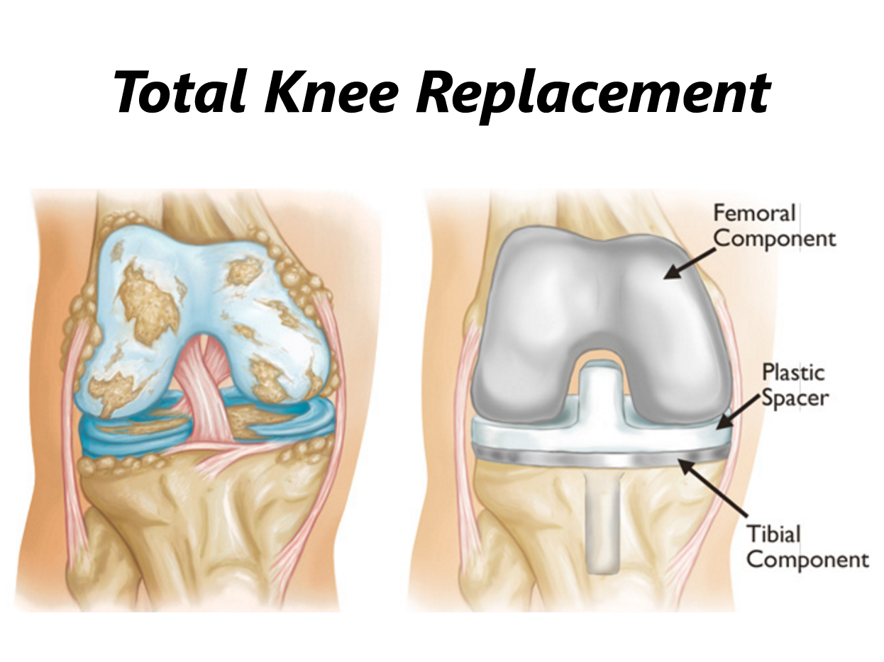 Total Knee Replacement Surgery