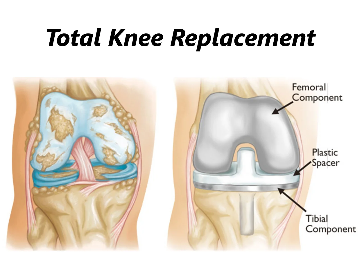 Total Knee Replacement Surgery