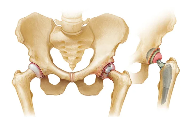 Total Hip Replacement Surgery