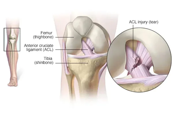 ACL Ligament Reconstruction Surgery