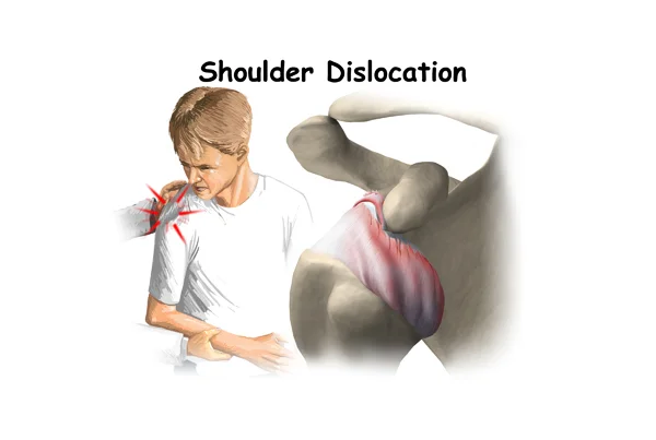 Shoulder Dislocation and Management