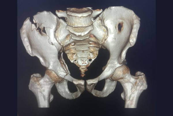 Pelvi - Acetabular Surgery