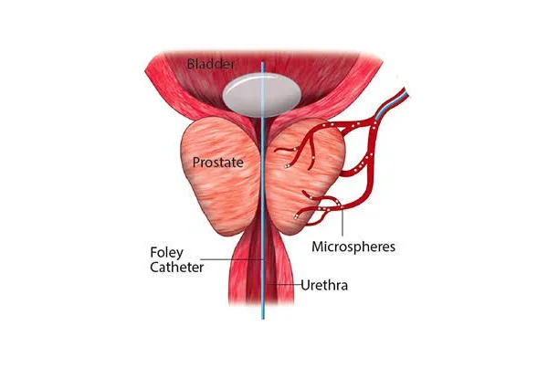 Prostatic Artery Embolization